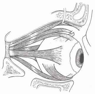Piirroksessa oikea silmä ulkosivulta kuvattuna. Silmän ulompi liikuttajalihas (rectus lateralis) sijoittuu piirroksessa silmän keskikolmanneksen tasolle. Lihas kiertää silmää poispäin keskilinjasta. Kyseinen lihas saattaa ärtyessään aiheuttaa toispuoleisen päänsäryn ja häiriöitä silmän motoriikassa, joka saattaa altistaa epävakauden ja huimauksen tuntemuksille silmien liikkeiden yhteydessä. Toistoliikkeet keskilinjasta toiselle ulkosivustalle enemmän saattavat lisätä rectus lateraliksen kiristystä ja altistaa oireille..